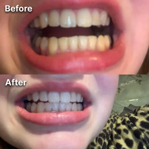 BetterSmile™ Colour Correcting Strips (1 Month Supply)