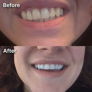 BetterSmile™ Colour Correcting Strips (1 Month Supply)
