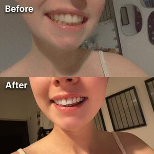 BetterSmile™ Colour Correcting Strips (1 Month Supply)